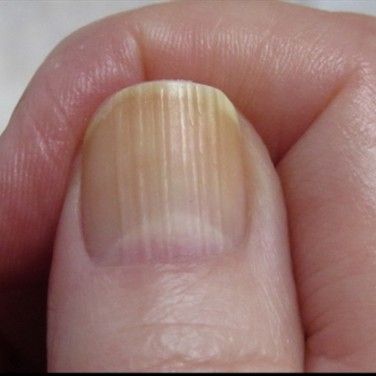 Ridges on Fingernails - Diseases Pictures