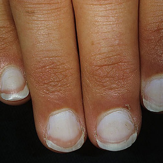 Nail Color Kidney Disease Confession Of Rose