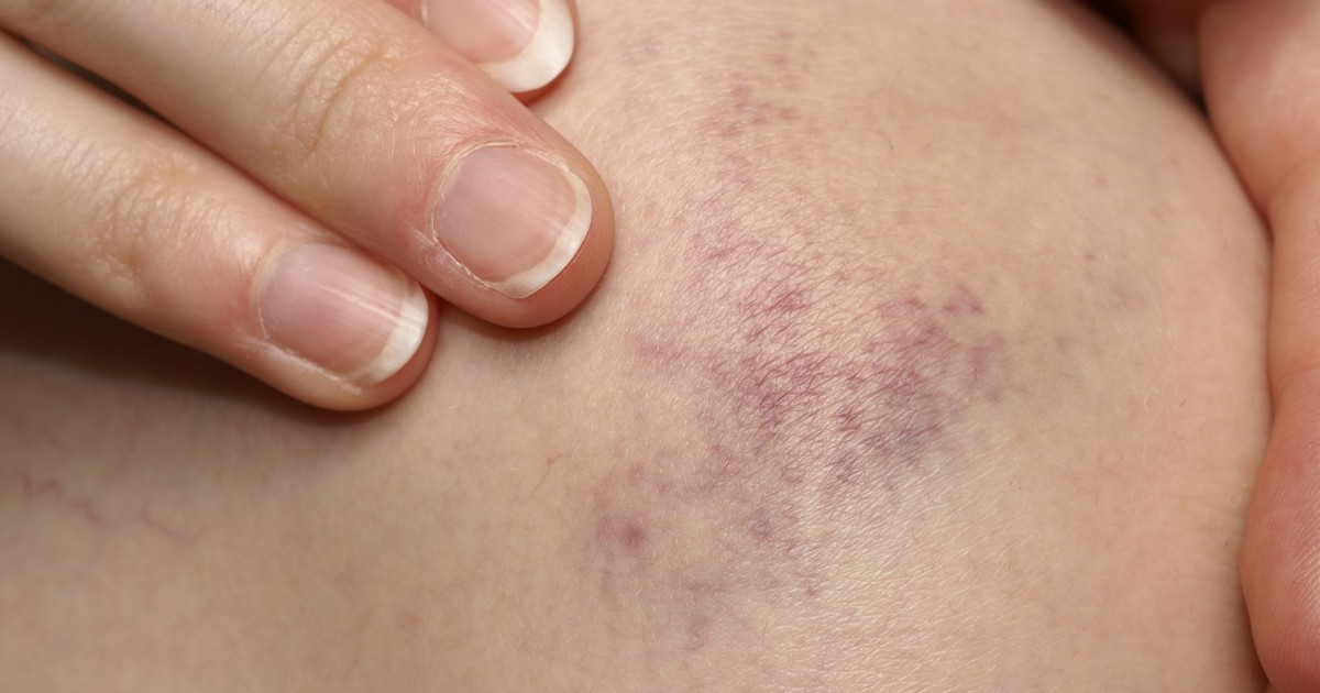 Bruising Easily: Should I Be Worried If I Bruise Easily ...