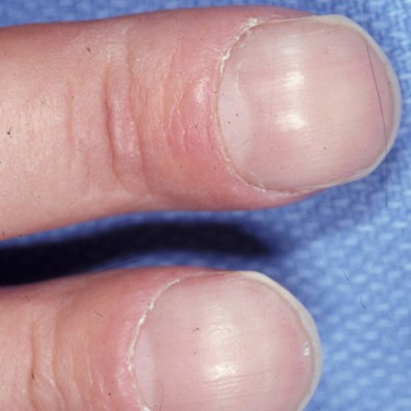 Watch out for these changes to your fingernails. 