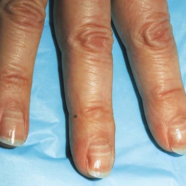 On fingernails indents small Slide show: