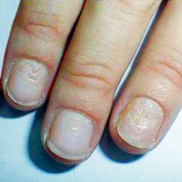 Small indents on fingernails